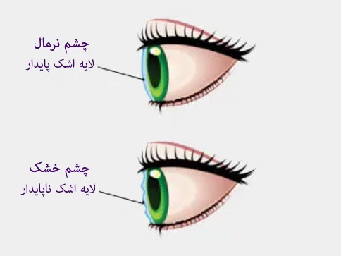 فرق بین چشم خشک و نرمال